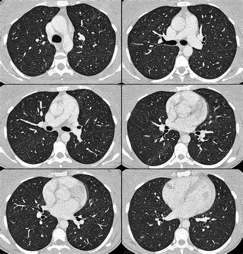 Normal Lungs And Heart Ct Scans Stock Image C0366931 Science