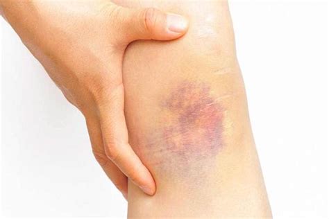 5 Causes Of Your Skin Bruising Easily Newsy Today