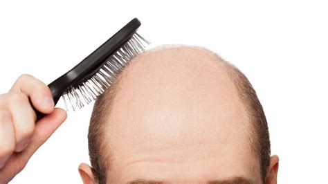 Historical Baldness Cures Mental Floss