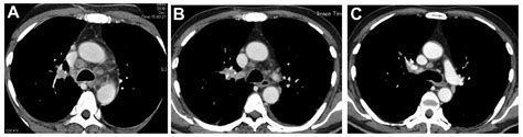 Lung Cancer With Spontaneous Regression Of Primary And Metastatic Sites