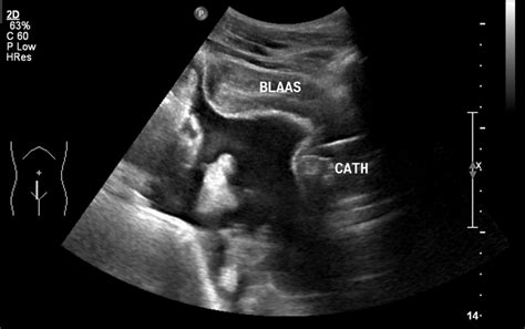 Abdominal Ultrasound After Catheter Placement Showing A Thickened