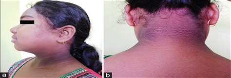 Childhood Acanthosis Nigricans Indian Journal Of Paediatric Dermatology