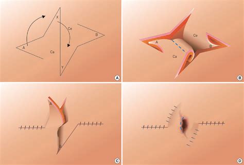 Figure 2 From A Novel Technique For Umbilical Reconstruction Using Four