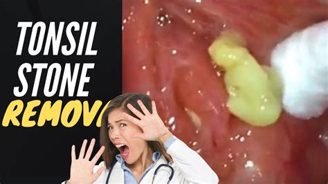 Tonsil Stone Removal Causes And Treatment What Are Tonsil Stones