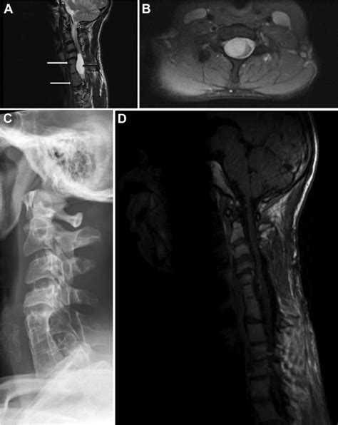 Preoperative Sagittal A And Axial B T2 Weighted Magnetic