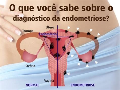 Tratamento Para Endometriose Causas E Sintomas Bedmed My XXX Hot Girl