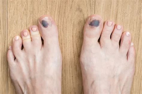 5 Tips To Prevent Black Toenails From Running Foot And Ankle Surgeon