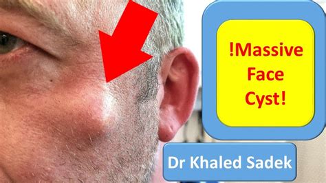 Year Face Cyst Cyst Removal Clinic London Dr Khaled Sadek Pimple Popping Videos