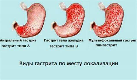 Как определить в домашних условиях кислотность желудка Картинка - Как определить в домашних условиях кислотность желудка