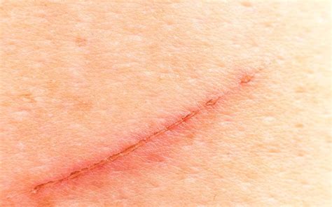 How To Keep A Cut From Scarring Alternativedirection12