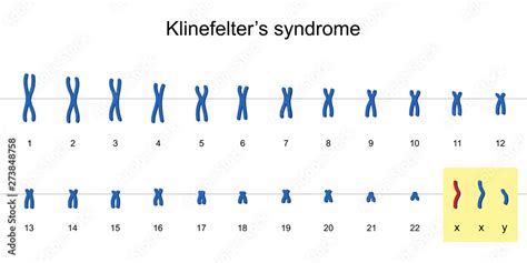 Klinefelters Syndrome Karyotype Stock ベクター Adobe Stock