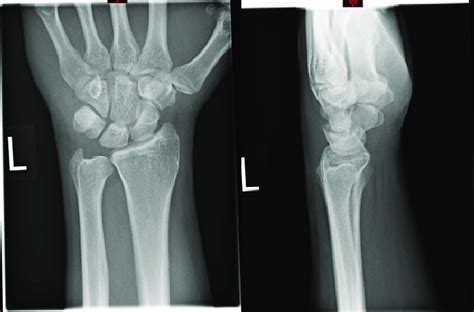 Radiograph At 3 Months Showing Pisiform Bone Anatomically Reduced And