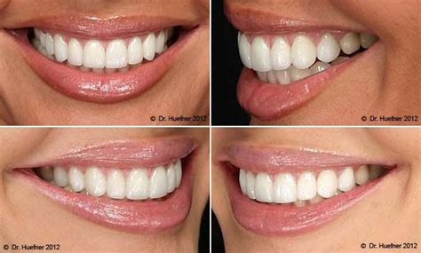 Get amazing perfect and confident smile teeth veneers free shipping! 25+ bästa Porcelain veneers idéerna på Pinterest | Kosmetisk tandvård, Tandvård och Dentalt