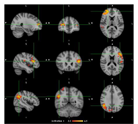 Figure 3 From Simultaneous Electroencephalography Functional Magnetic Resonance Imaging For