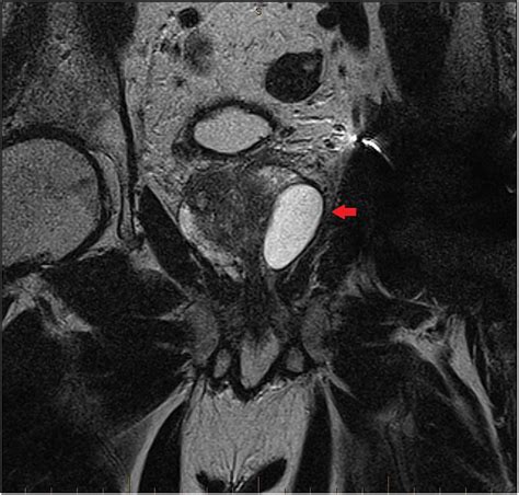 A Large Benign Prostatic Cyst Presented With An Extremely High Serum