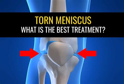 Meniscus Tear Treatment Torn Meniscus Exercises