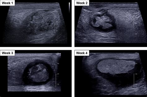 Sonographic Features Of Abscess Maturation In A Porcine Model