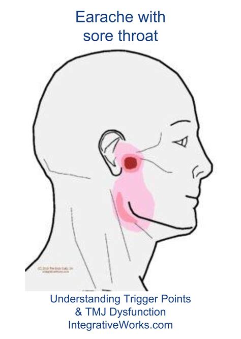 Trigger Points Earache And Sore Throat Integrative Works