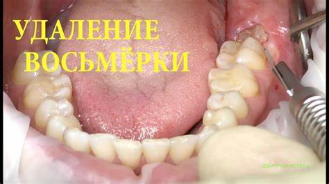Диета при удаление зубов мудрости Удаление зуба мудрости.Полное видео. - YouTube Удаление зуба мудрости.Полное видео. - YouTube Диета при удаление зубов мудрости