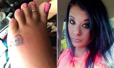 Florida Woman Contracted Flesh Eating Bacteria After Going Swimming With A Cut On Her Foot