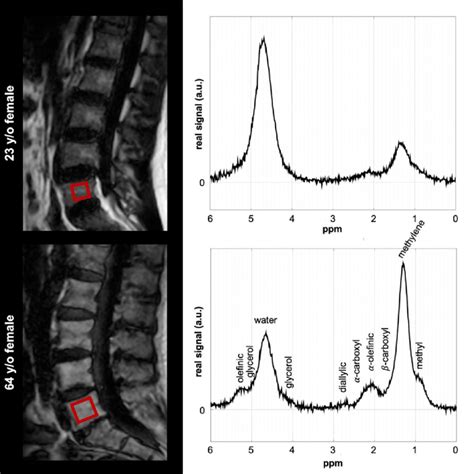 Magnetic Resonance Spectroscopy Mrs Of The Lumbar Spine Fat Images