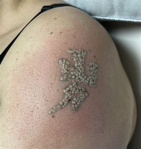 Laser Tattoo Removal Hayley S Hair Removal And Aesthetics Poole