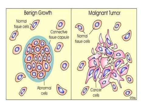Differences Between A Malignant And Benign Tumor