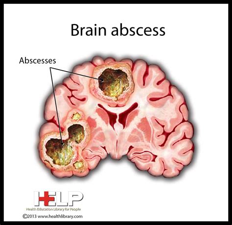 Brain Abscess Nclex Nurse Practioner Nclex Study