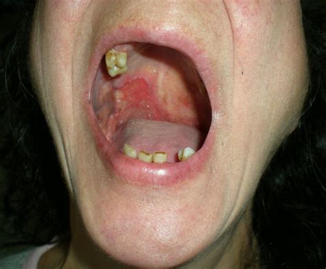 Oral Squamous Cell Carcinoma Cheek
