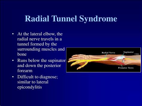 Radial Tunnel Syndrome Pastoruser