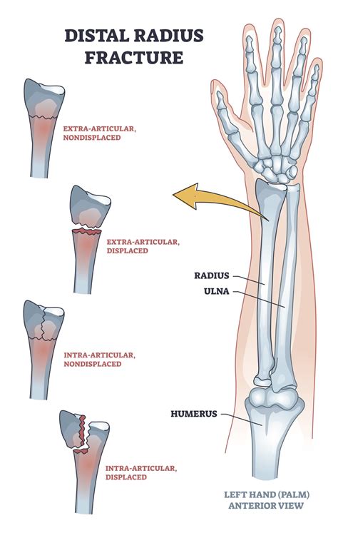 Different Types Of Distal Radius Fractures Seen In The Hand Therapy Clinic