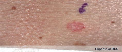 Skin Cancer Early Detection