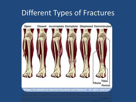 Different Types Of Fractures A Simple Classification Of Fractures Images
