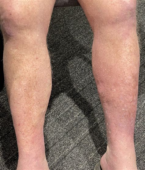 Unilateral Leg Swelling Chronic Venous Stasis Vs Lymphedema