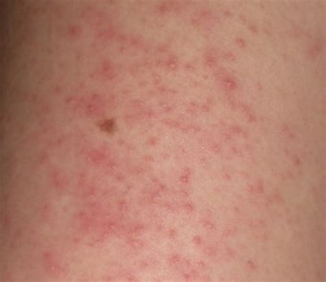 Stress Rashes Pictures Photos