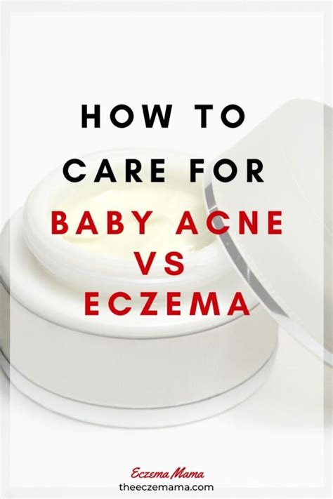 How To Care For Baby Acne Vs Eczema Eczema Mama