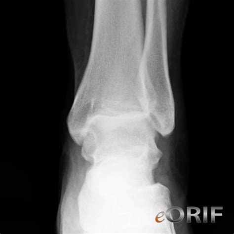 Ankle Dislocation Cases Eorif
