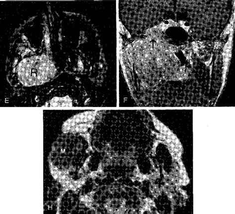 Figure 12 From Head And Neck Lesions Radiologic Pathologic