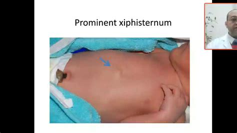 Case 135 Protruding Xiphoid Process Is It Normal Is It Hernia Why