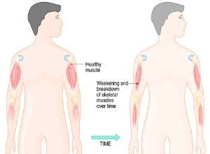 Dans le cas de la plupart des maladies neurologiques ou neuromusculaires, il n'existe pas de traitement. Dystrophie musculaire : définition et symptômes - Santé ...