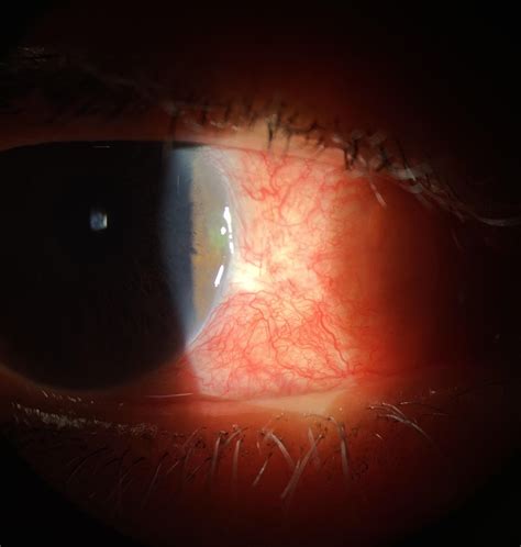 Episcleritis Roptometry