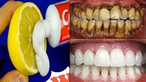 How To Remove Dental Plaque 3 Minutes Naturally Youtube