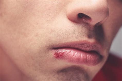 Cause Of Your Mouth Sore In Rockledge Cold Sore Treatment Oral Blister