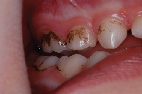 Discoloration Of Teeth Visual Diagnosis And Treatment In Pediatrics