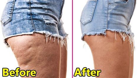 How To Remove Cellulite From The Back Of Legs Just In 3 Days How To
