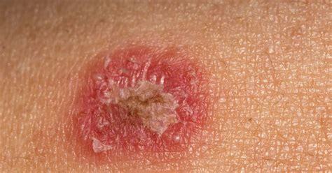 How To Get Rid Of Ringworm Overnight Home Remedies For Ringworm 11