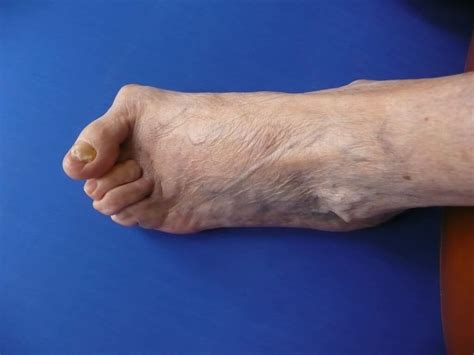 Bunions And Hammer Toes Clinique Podiatrique De Lestrie