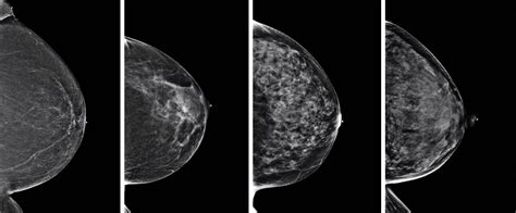 Dense Breast Tissue Quiz Ohio State Health And Discovery