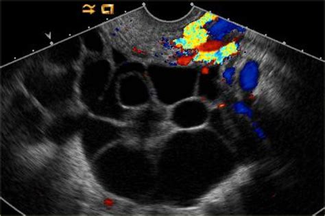 Ovarian Cancer Ultrasound Color Doppler Using Color Doppler To