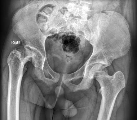 Avascular Necrosis Of The Hip Radiology Reference Article